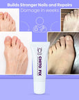 Chitofix Toenail Fungus Treatment Extra Strength Cream with Chitosan, Athletes Foot Treatment, Nail Fungus Treatment for Toenail and Fingernail, Yellow Toenail Treatment 0.33 Fl Oz