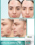 Garnier Pure Active: Anti-Acne Pore Strips with Salicylic Acid & Tea Tree Oil - Blackhead Remover, Facial Cleanser (22 Strips) Garnier Pore Strips: Blackhead Remover with Salicylic Acid pore strips, anti-acne strips, blackhead remover, salicylic acid strips, tea tree oil acne treatment, facial pore cleanser, acne treatment strips, blackhead removal strips, acne treatment, blackhead removal, pore cleansing, salicylic acid, tea tree oil, skincare, beauty, facial care, oily skin, acne-prone skin, blemishes, cl