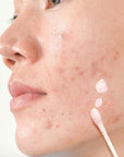 Luv it! Acne Treatment Lotion - Salicylic Acid & Tea Tree Oil for Acne-Prone Skin, 30ml Luv it! Acne Treatment Lotion - Salicylic Acid & Tea Tree Oil acne treatment lotion, salicylic acid skincare, tea tree oil benefits, acne prone skin care, natural acne treatment, skincare, acne solution, natural skincare, salicylic acid benefits, tea tree oil skincare, acne prevention, skincare routine, clear skin, healthy skin, acne care, skincare products