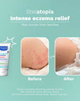 Mustela Stelatopia Intense - Non-Corticosteroid Cream | 30 ml
