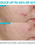 La Roche Posay Effaclar Ultra Concentrated Serum 30ml